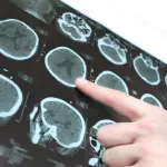 Aspirina liquida 10 volte più potente della chemio contro tumore al cervello