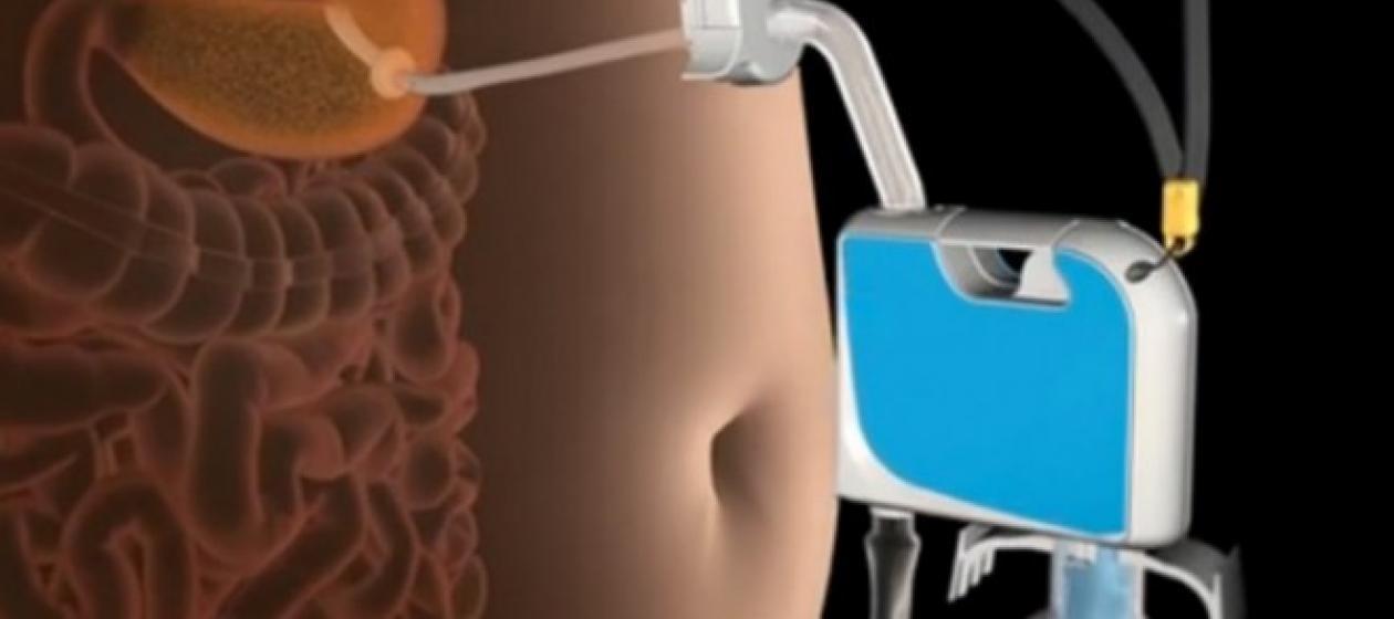 Perdere peso velocemente con tubo di gomma nell'addome che aspira cibo in eccesso