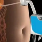 Perdere peso velocemente con tubo di gomma nell'addome che aspira cibo in eccesso