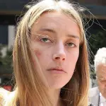 Amber Heard picchiata da Johnny Depp: viso tumefatto