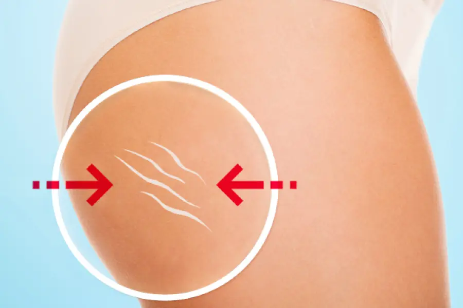 Cos’è la cellulite e come combatterla