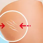 Cos’è la cellulite e come combatterla