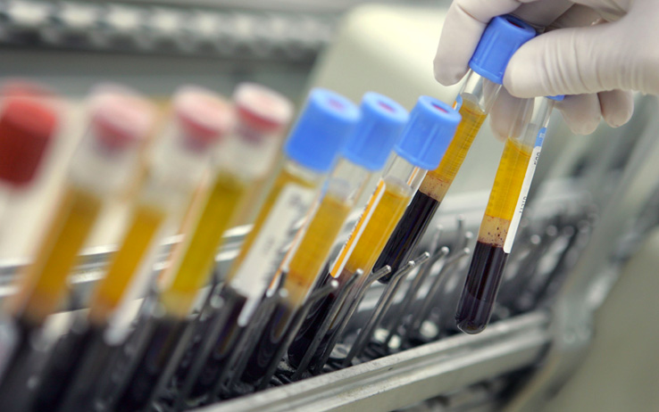 Tumore al rene annientato con immuno-oncologia