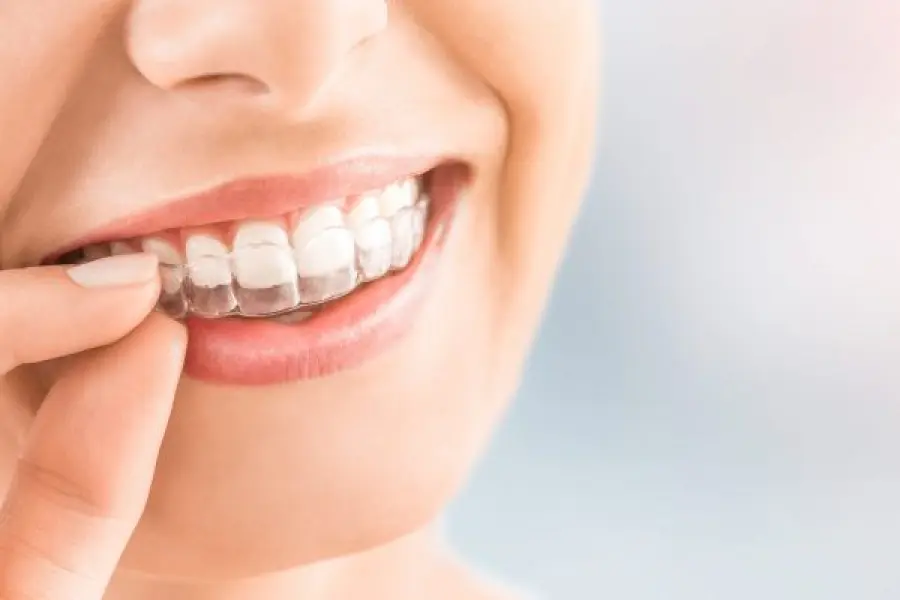Sorriso più bello con il trattamento Invisalign