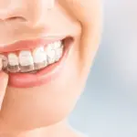 Sorriso più bello con il trattamento Invisalign