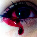 Perde sangue dagli occhi: la misteriosa malattia di Marnie