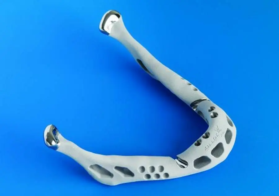 Primo Trapianto di Mandibola in Italia: Padova Eccellenza Sanità