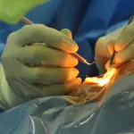 Chirurgia della cataratta: quando effettuare l'intervento?