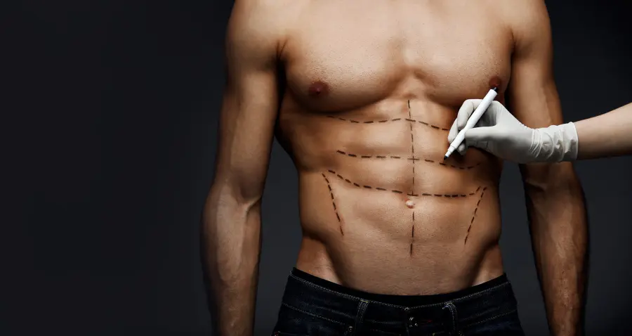 Liposuzione, interventi sugli uomini in crescita: ecco come e quando farla