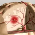 Trombectomia Meccanica 'Ripulisce' Arterie: Ictus Addio