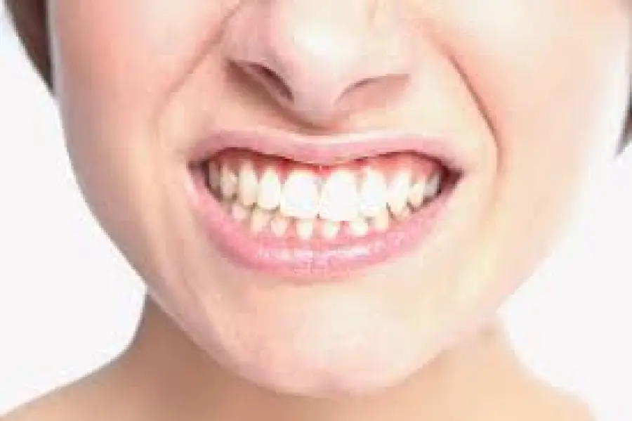 L'ansia che consuma i denti: come curare il bruxismo