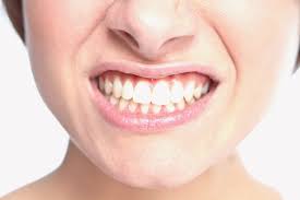 L'ansia che consuma i denti: come curare il bruxismo