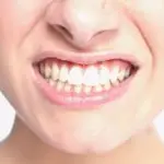 L'ansia che consuma i denti: come curare il bruxismo