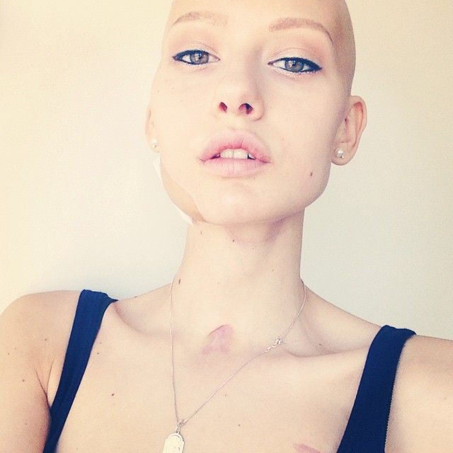 Elizaveta Bulokhova: modella che ha sconfitto cancro alla mandibola, foto su Instagram