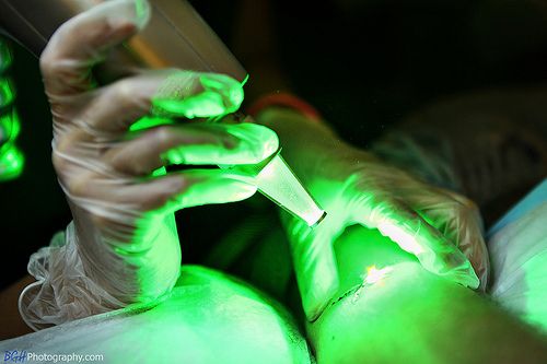 Tatuaggio: rimuoverlo è più difficile che farlo