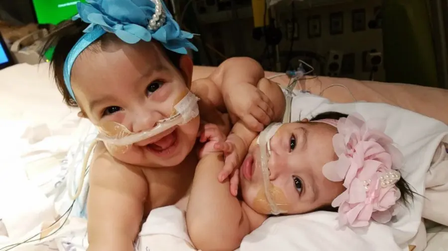 Texas, gemelline siamesi nascono al Corpus Christi Medical Center: lanciata raccolta fondi