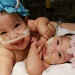 Texas, gemelline siamesi nascono al Corpus Christi Medical Center: lanciata raccolta fondi