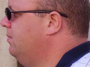 Doppio mento: niente più liposuzione, farmaco lo scioglie