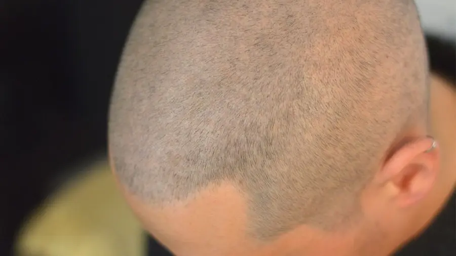 Pigmentazione capelli, soluzione definitiva contro calvizie ed inestetismi