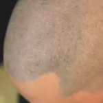 Pigmentazione capelli, soluzione definitiva contro calvizie ed inestetismi