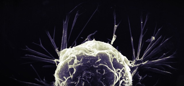 Tumore è questione di sfortuna: studio choc contestato da comunità scientifica