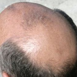 Caduta dei capelli: staminali per risolvere problema, pelata addio