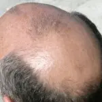Caduta dei capelli: staminali per risolvere problema, pelata addio