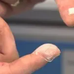 Cerotto sostituirà siringa: paura dell'ago addio! Invenzione irlandese