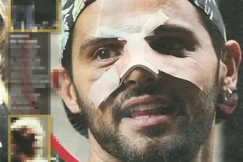 Alessio Lo Passo: nuova operazione dopo l’aggressione?