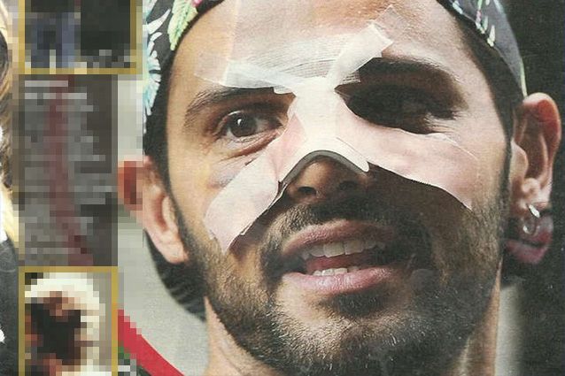 Alessio Lo Passo: nuova operazione dopo l’aggressione?