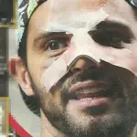 Alessio Lo Passo: nuova operazione dopo l’aggressione?