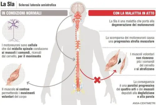 Dati allarmanti riguardanti la diffusione della SLA entro il 2040