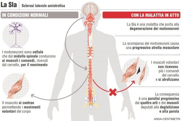 Dati allarmanti riguardanti la diffusione della SLA entro il 2040