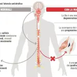 Dati allarmanti riguardanti la diffusione della SLA entro il 2040
