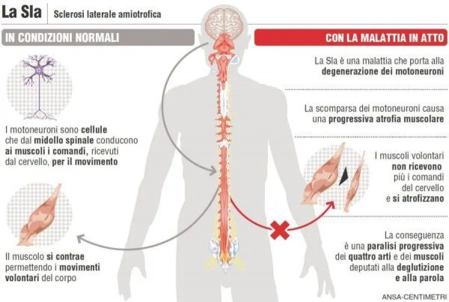 Dati allarmanti riguardanti la diffusione della SLA entro il 2040