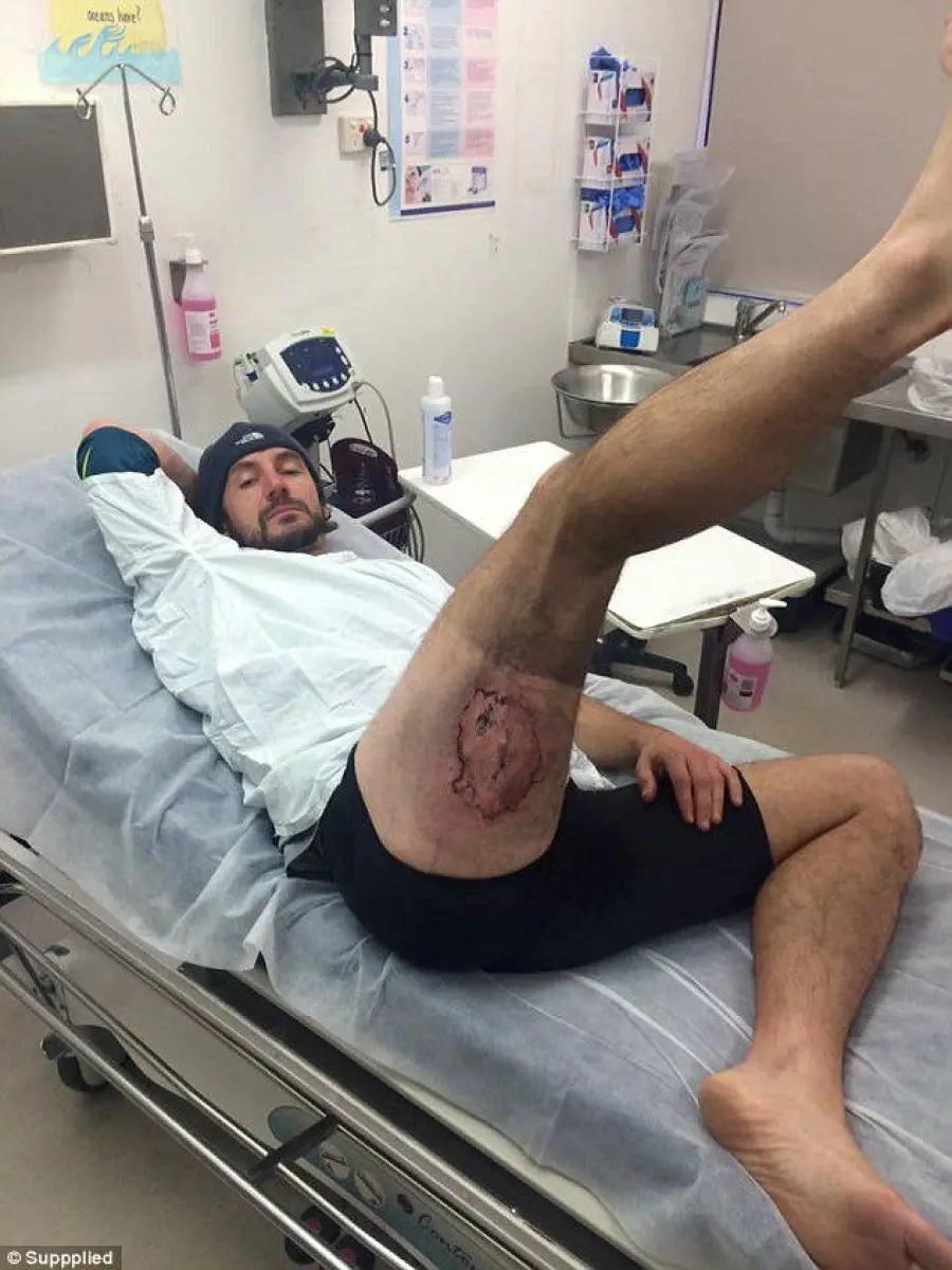 iPhone esplode: ciclista ustionato