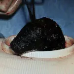 Palla di capelli nello stomaco di Sophie Cox, ragazza affetta da tricofagia