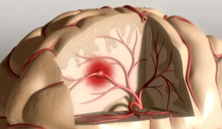 Ictus: Trombectomia Meccanica per Curarlo