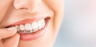 Invisalign