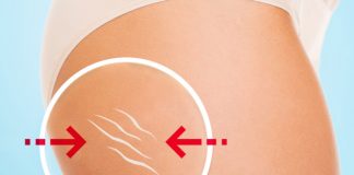 cellulite